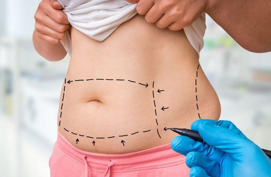 Your Guide to a Tighter Tummy: Detailed Information on Abdominoplasty with Dr Tavakoli Your Guide to a Tighter Tummy: Detailed Information on Abdominoplasty with Dr Tavakoli
